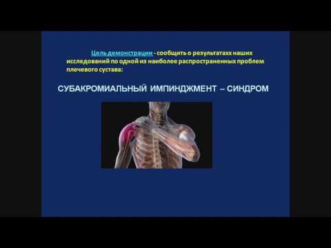 Боль в плечевом суставе, импиджмент синдром