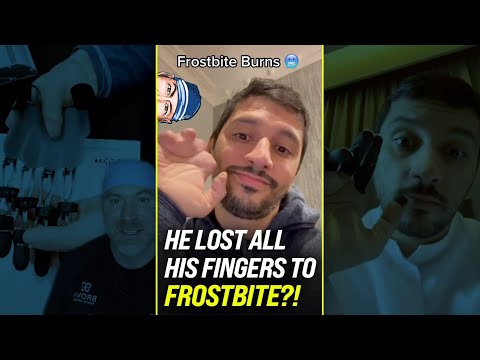 Unreal, He Lost All His Fingers to Frostbite?! 🥶 #shorts