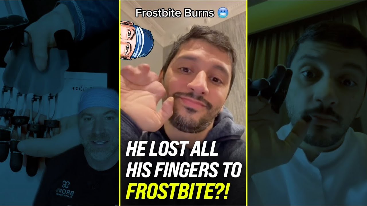 Unreal, He Lost All His Fingers to Frostbite?! 🥶 #shorts