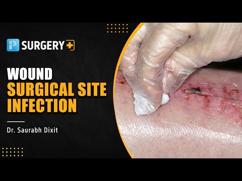 Wound - Surgical Site Infection | Surgery by Dr. Saurabh Dixit | PrepLadder NEET-SS