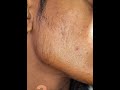 Minoxidil  5% Beard oil 3 months Beard grow video 📹 R,RD Bhai 💯