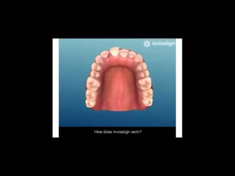 Invisalign - A Revolutionary Way To Straighten Your Teeth Invisibly