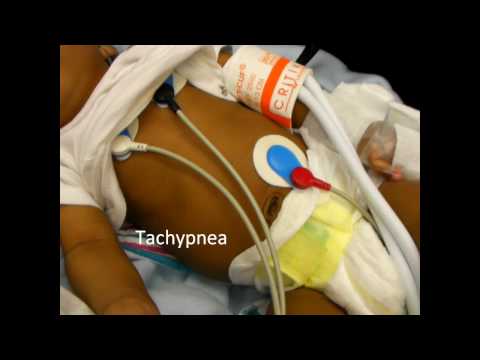 Infant Respiratory Distress Signs