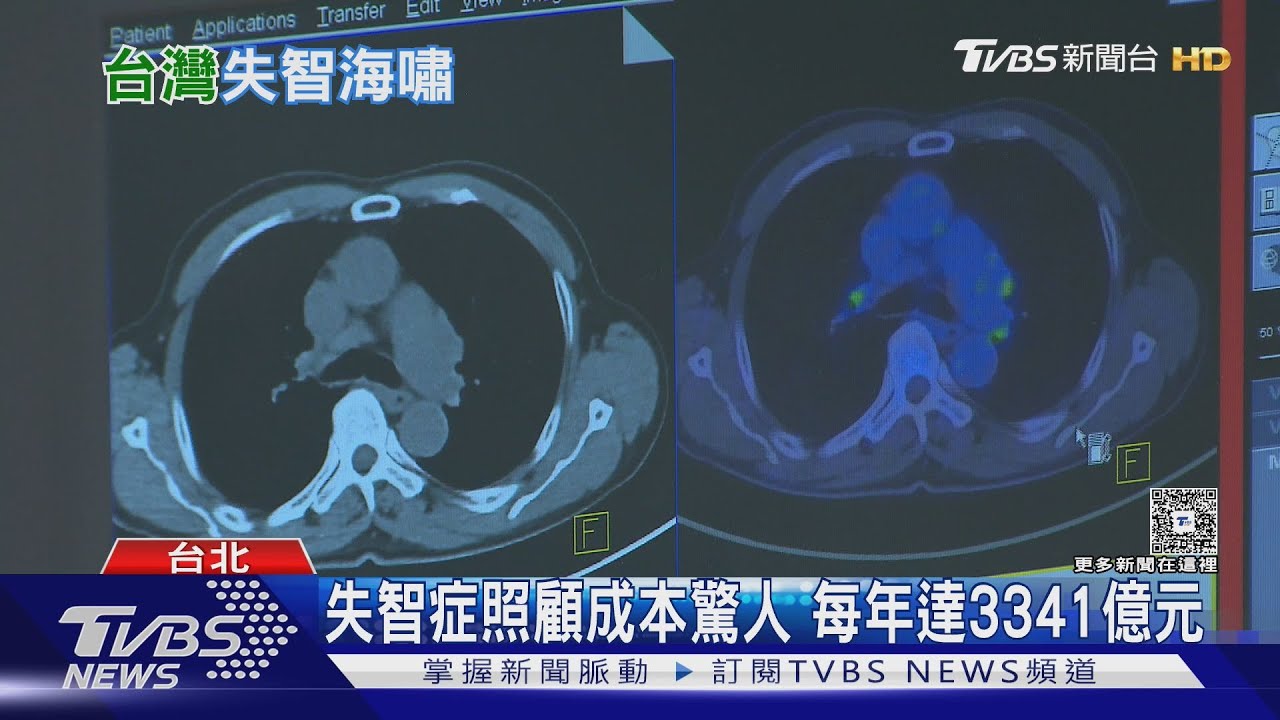 失智照顧驚人成本曝!飆上3千億 「這生活習慣」比遺傳更致命