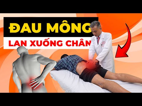 TẠI SAO ĐAU MÔNG LAN XUỐNG CHÂN KHIẾN BẠN MẤT NGỦ? Giải Pháp Từ Chuyên Gia