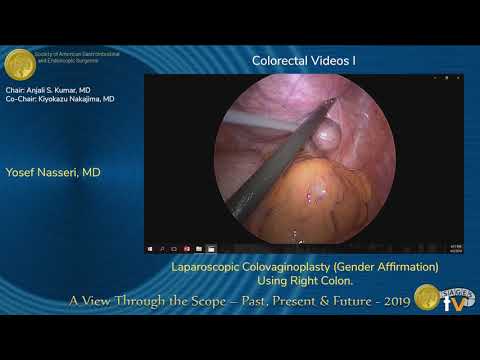 Colovaginoplastia laparoscópica (afirmación de género) con colon derecho