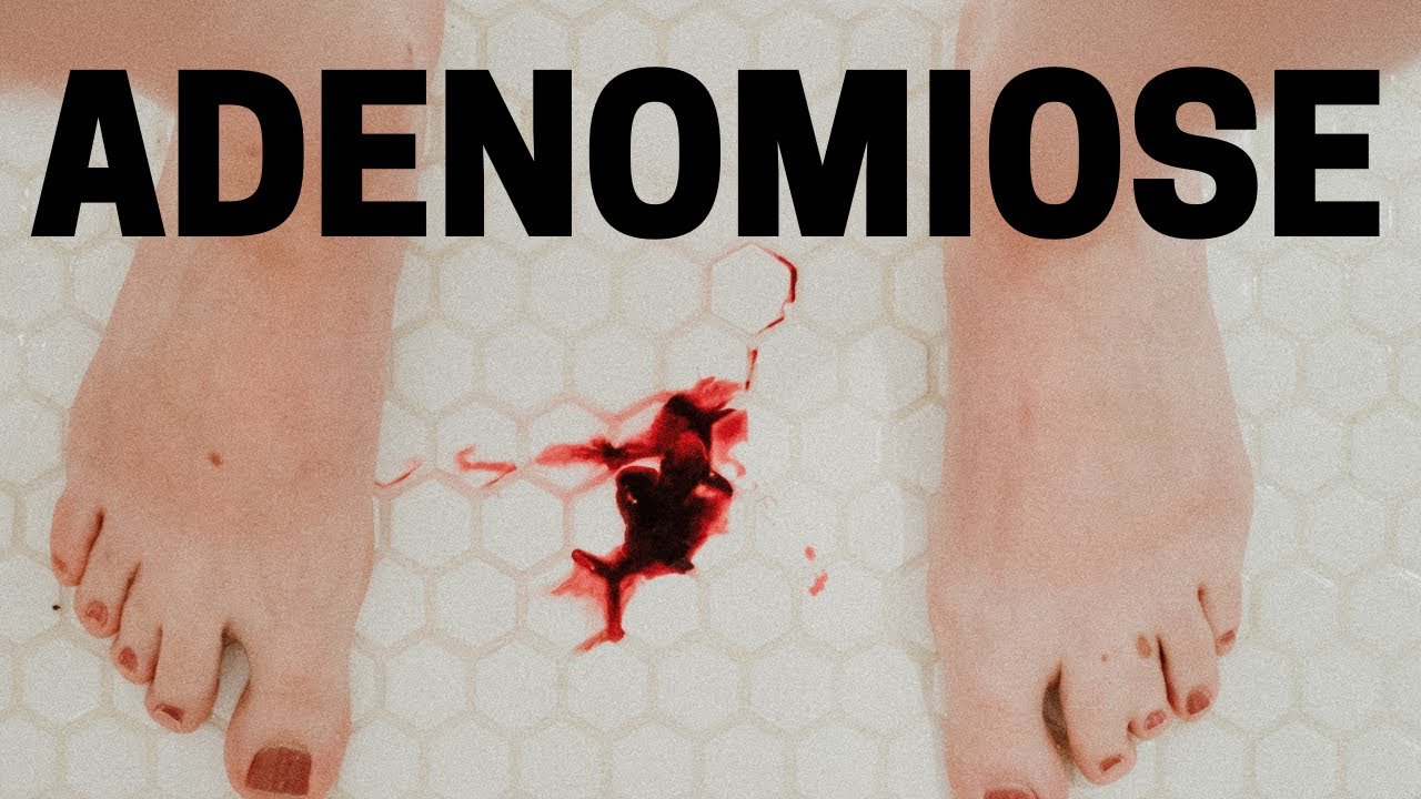 ADENOMIOSE UTERINA – SINTOMAS E TRATAMENTO