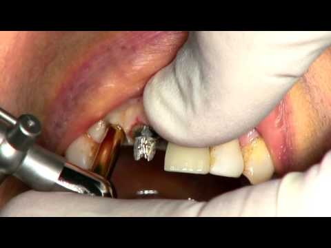 Explantation of Osseointegrated Implant with Neobiotech Fixture Removal kit - Nikos Mattheos 