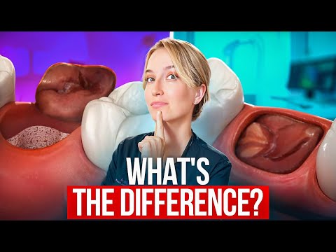 DRY SOCKET VS. NORMAL HEALING