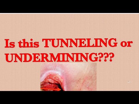 Wound Care : Tunneling Versus Undermining