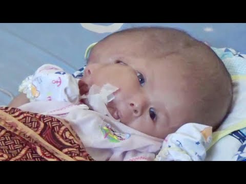 Parents Pray for Miracle After Their Baby Is Born With 2 Faces