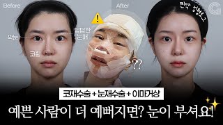 예쁜 사람이 더 예뻐지면? 눈이 부셔요! (눈재수술+코재수술+이마거상)