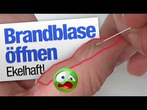 Lokobejs von der Schuppenflechte Metodschekt und die Schuppenflechte
