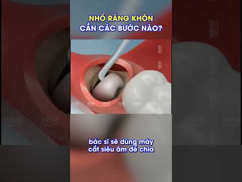 Nhổ răng khôn/ răng số 8 cần các bước nào? ( Wisdom tooth extraction)