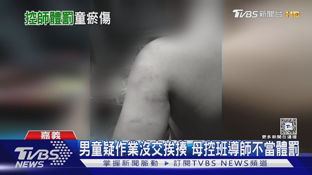 男童疑作業沒交挨揍滿身傷!母控班導師不當體罰