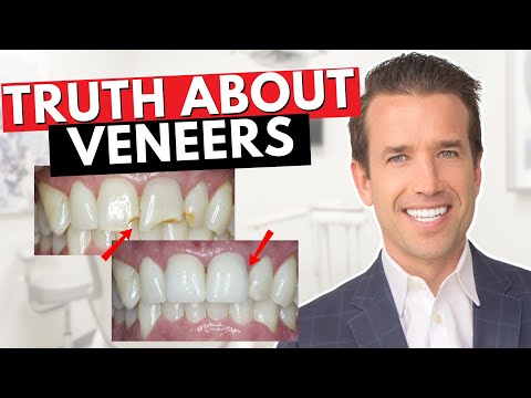 YouTube video about: How often do you have to replace veneers?