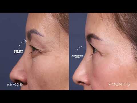 Upper Blepharoplasty Results | Droopy Eyelids to Youthful Eyes