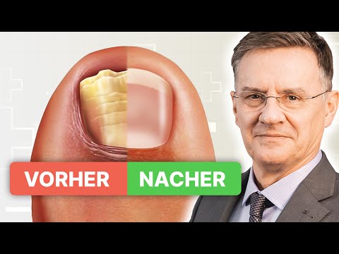 Nagelpilz bekämpfen in nur 3 einfachen Schritten