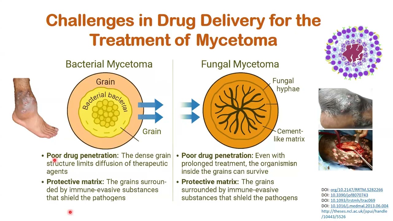 22nd Mycetoma Research Club: Nanomedicine for Treatment and Prevention of Mycetoma Disease