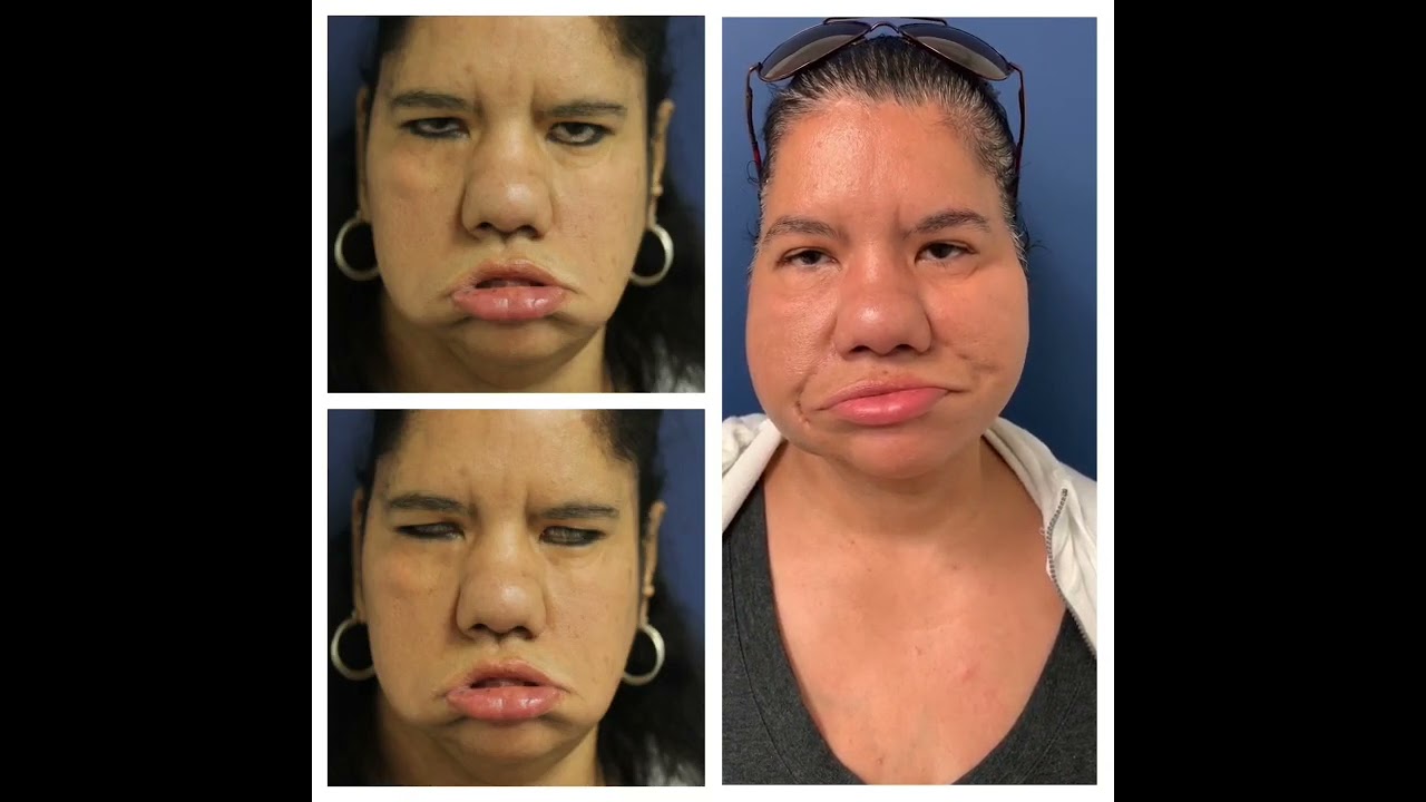 Bilateral Gracilis, Moebius Syndrome, Browlift | Joshua Rosenberg, MD New York, NY | Staten Island