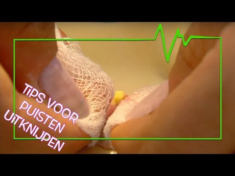 PUISTEN GOED UITKNIJPEN (TIPS!) - TOPDOKS SPECIALISME