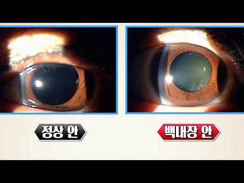 발병 가능성 100% 백내장과 노안 구별법