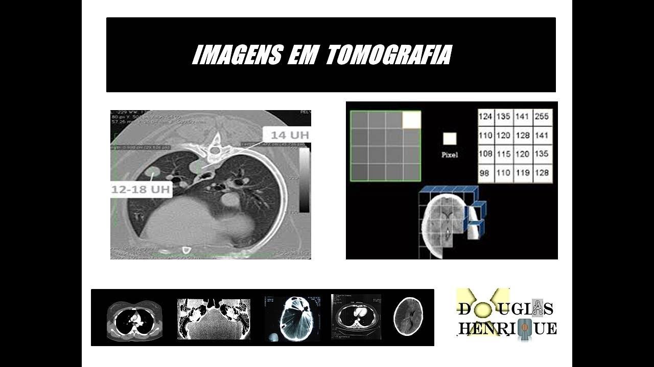 ESCALA DE HOUNSFIELD ( HU ) E FORMAÇÃO DA IMAGENS EM TOMOGRAFIA