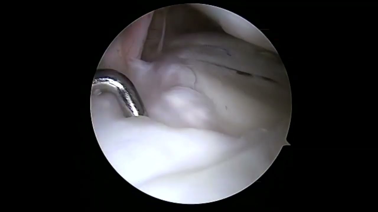 Second look after lateral meniscus transplant