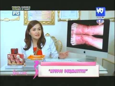 Eczema a bambini di trattamento Come trattare rimedi di gente di eczema secchi