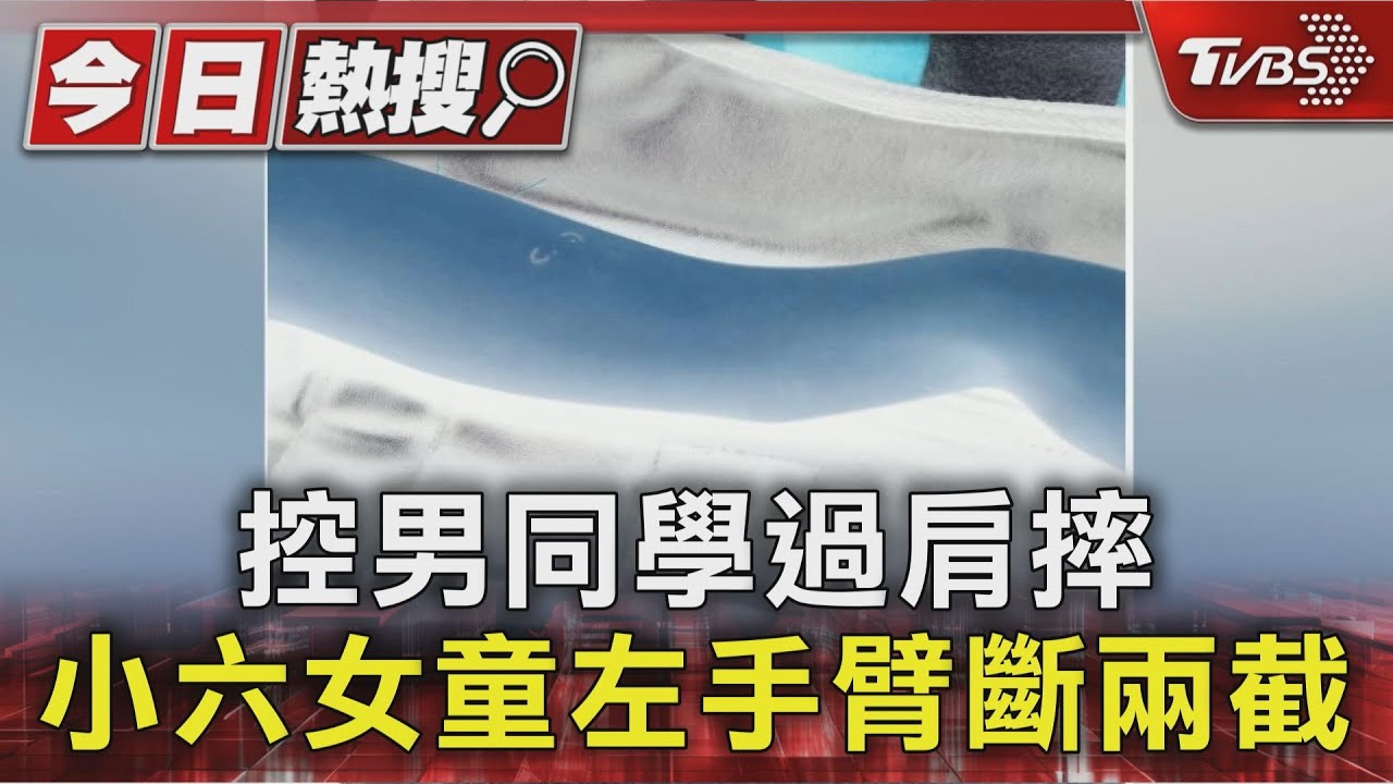 獨／小六女童遭過肩摔「手臂2處骨折」　男同學未滿12歲無法提告