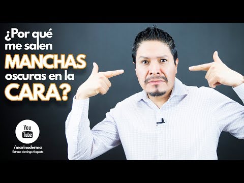 Why do I get dark spots on my face? Dr. Marino, dermatologist