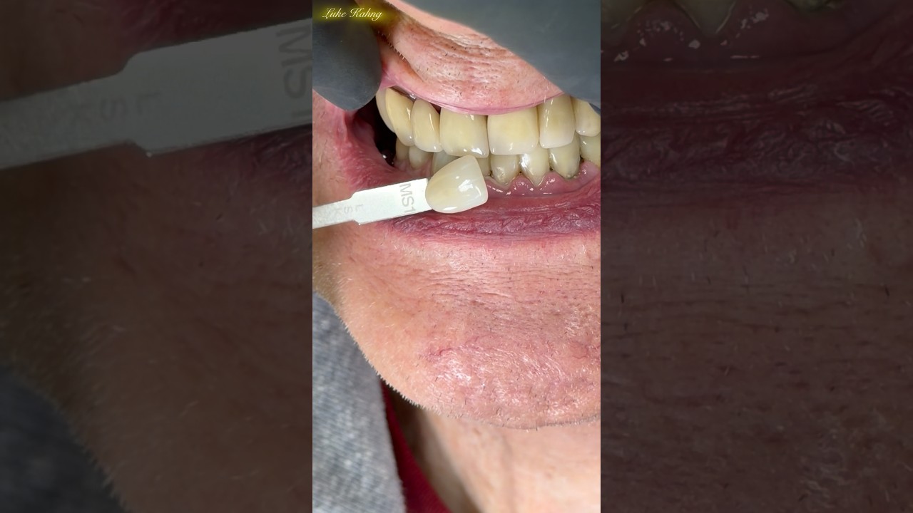 Shade matching in my lab today using Chairside Shade Guide 8.0