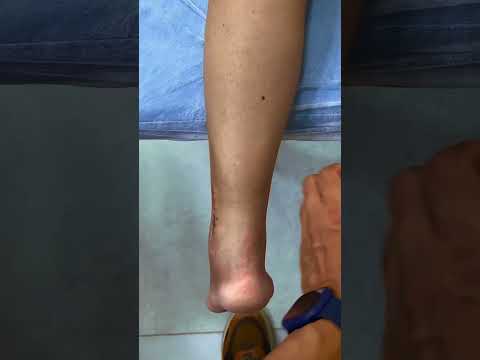 Demorar para iniciar a fisioterapia pode atrasar sua recuperação #fisioterapia #tornozelo #cirurgia