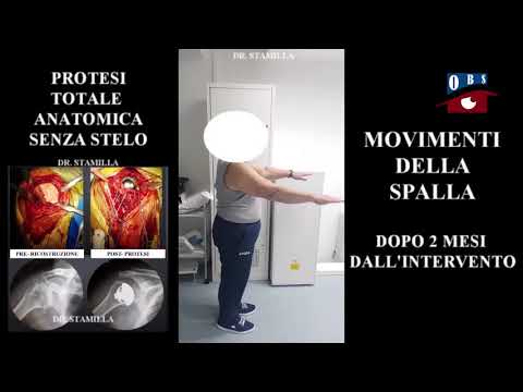 PROTESI DI SPALLA ANATOMICA E INVERSA 3D DR STAMILLA MARCELLO – OSSERVATORIO BUONA SANITA’