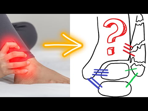 Ankle Fractures: Do I NEED SURGERY?