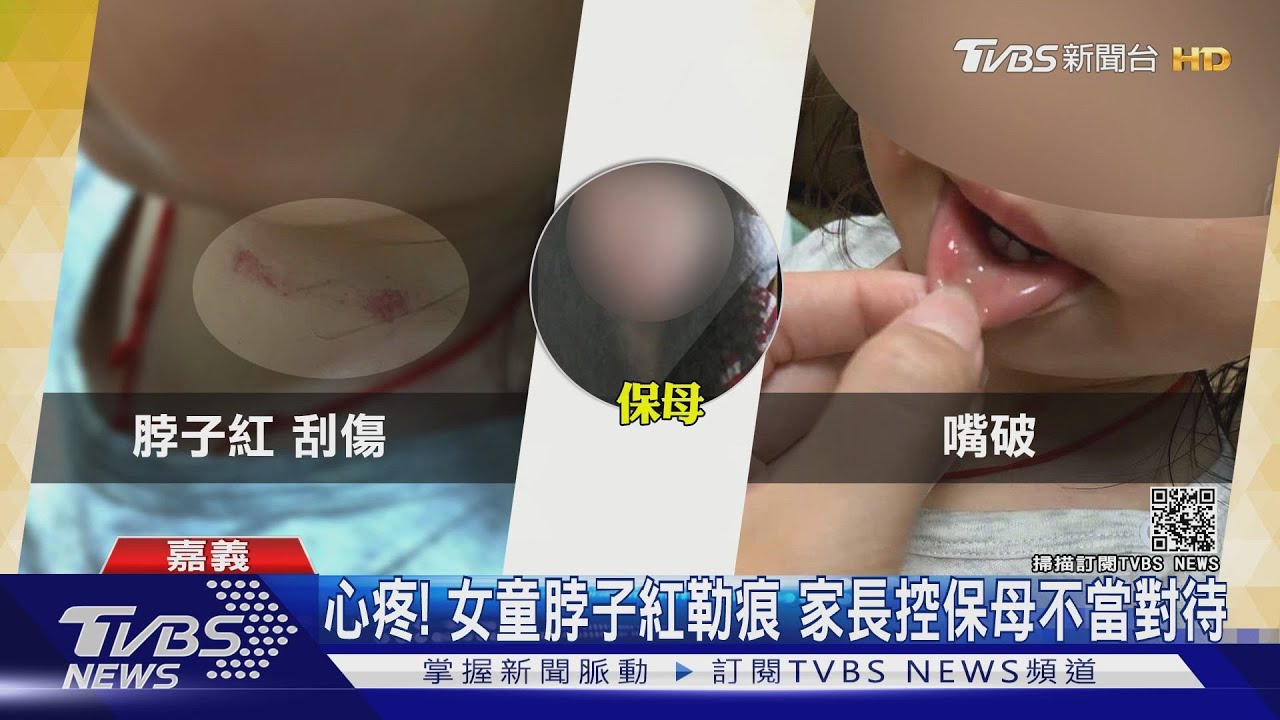 女童脖子紅勒痕!家長控保母不當對待 保母喊冤