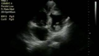 preview picture of video 'dilated cardiomyopathy with multiple LV thrombi 2/2'