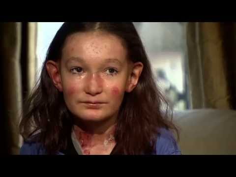Celebrities lend support to girl with agonising skin condition | 5 News