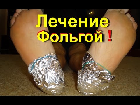 Как лечить синовит суставов Боль в спине при плоскостопии