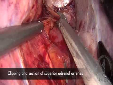 Laparoscopic Adrenalectomy Right Side