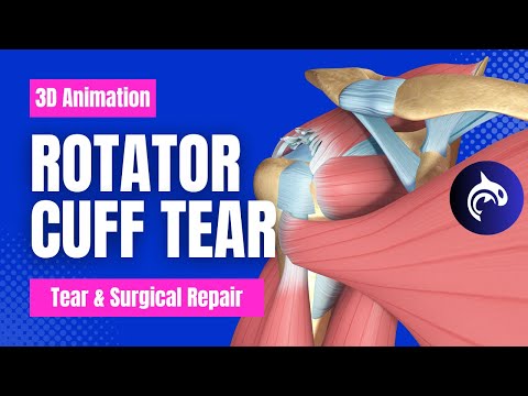 SLAP Tear and Repair 3D Animation No Narration