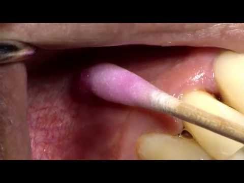 Cetacaine topical anesthetic gel