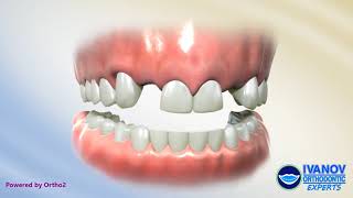 Space Regaining Appliance