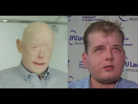 Burned Firefighter Receives Face Transplant