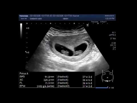 When Can Twins Be Seen on Ultrasound? (Plus Early Signs)