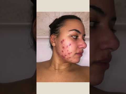 12 Weeks Differin cream 0.1%  Doxycycline 100mg for hormonal acne results #shorts