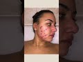 12 Weeks Differin Cream 0 1 Doxycycline 100mg For Hormonal Acne Results Shorts