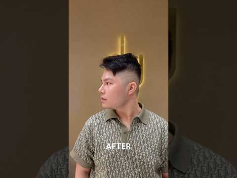 Male rhinoplasty and Alarplasty using his own rib cartilage and DCF.