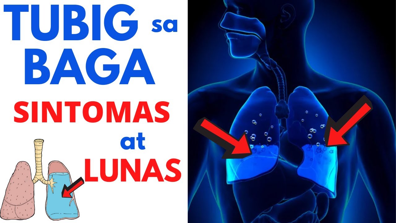 Putar video 🫁 15 SINTOMAS ng TUBIG sa BAGA | Pneumonia ba o iba Paano gamutin o operation Mga SANHI at LUNAS sekarang 🫁 15 SINTOMAS ng TUBIG sa BAGA | Pneumonia ba o iba Paano gamutin o operation Mga SANHI at LUNAS