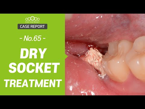 Dry Socket Treatment 